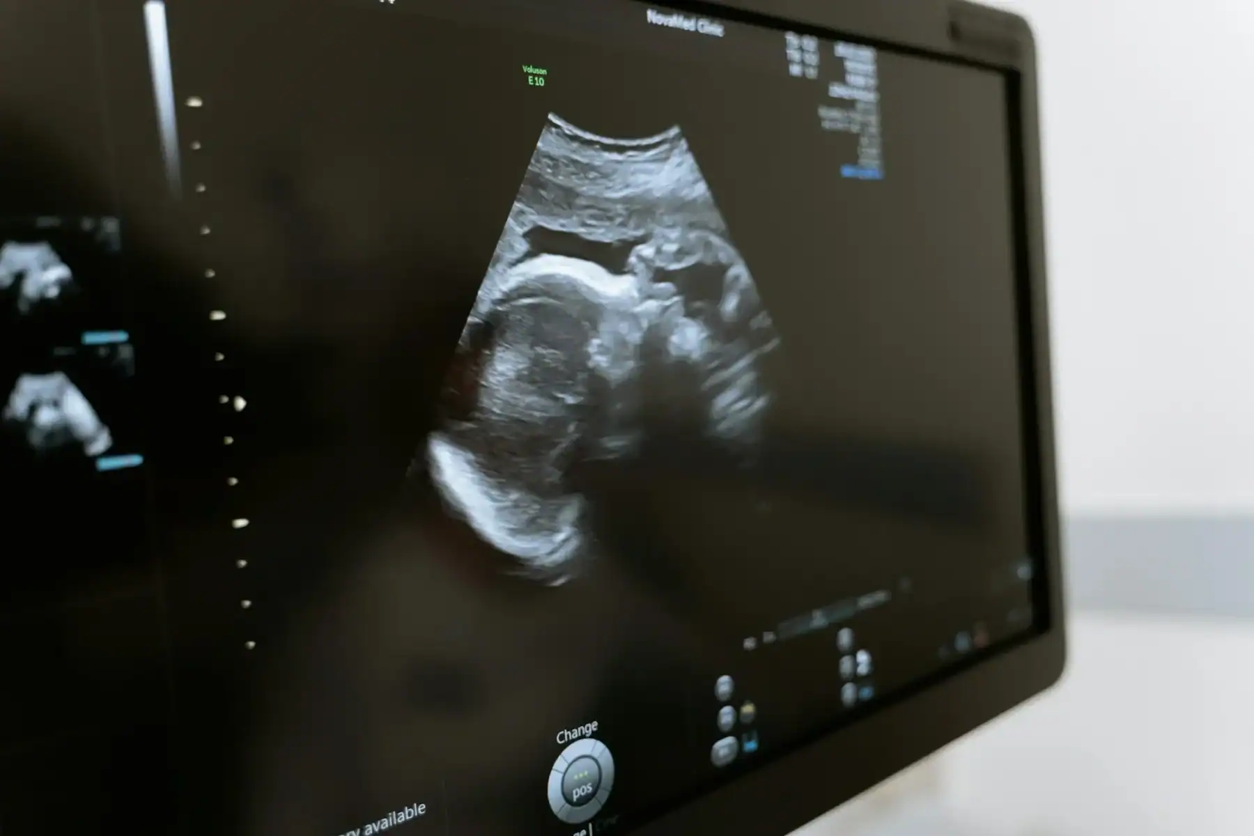 affordable ultrasound scan cost without insurance