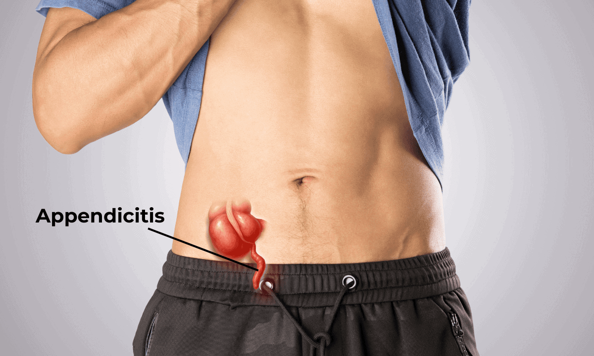 appendix ultrasound